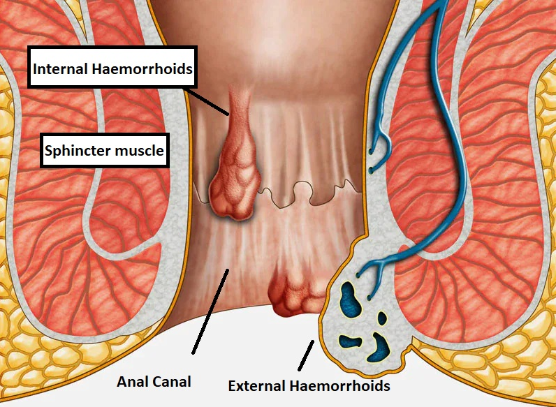 Haemorrhoids Dr Russell Manley General Surgeon Gold Coast